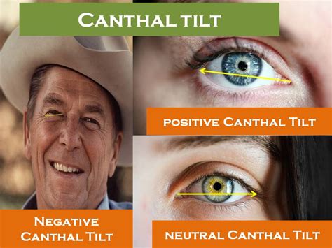 canthal tilt